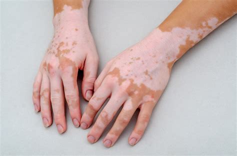 vitiligo disease